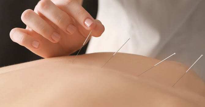 Acupuncture